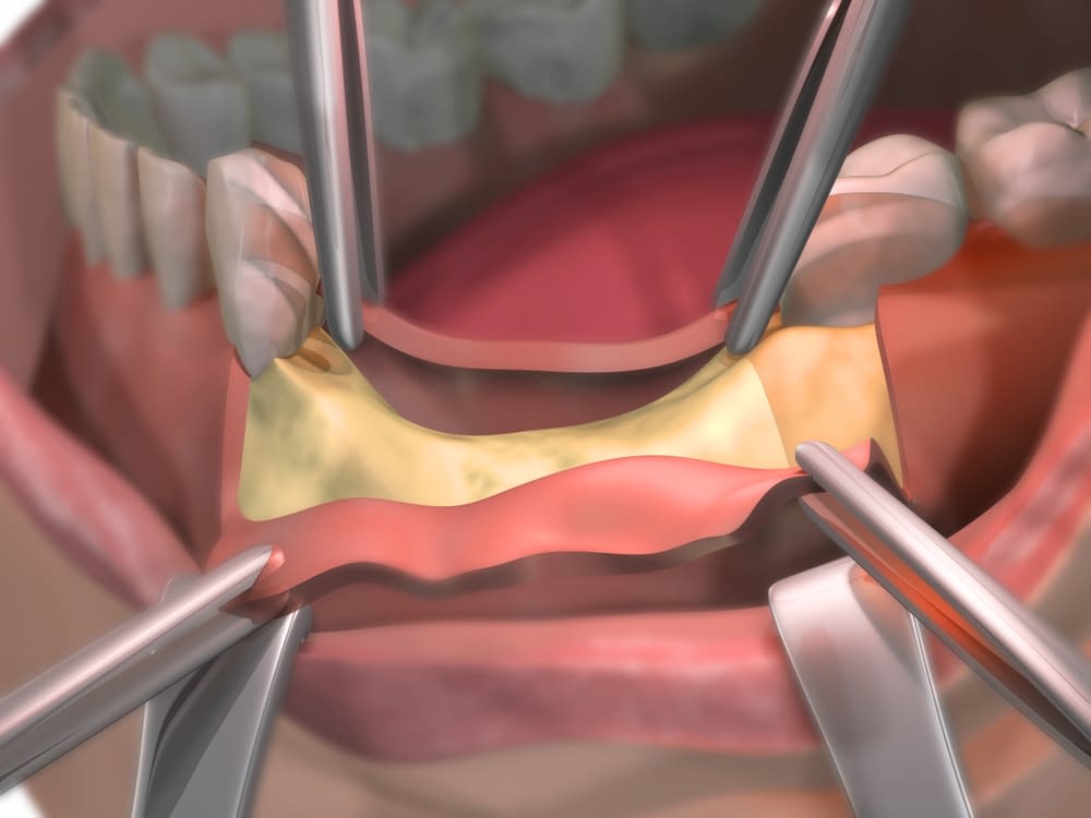 How Does Bone Grafting for Dental Implants Work? Cedarhurst, NY